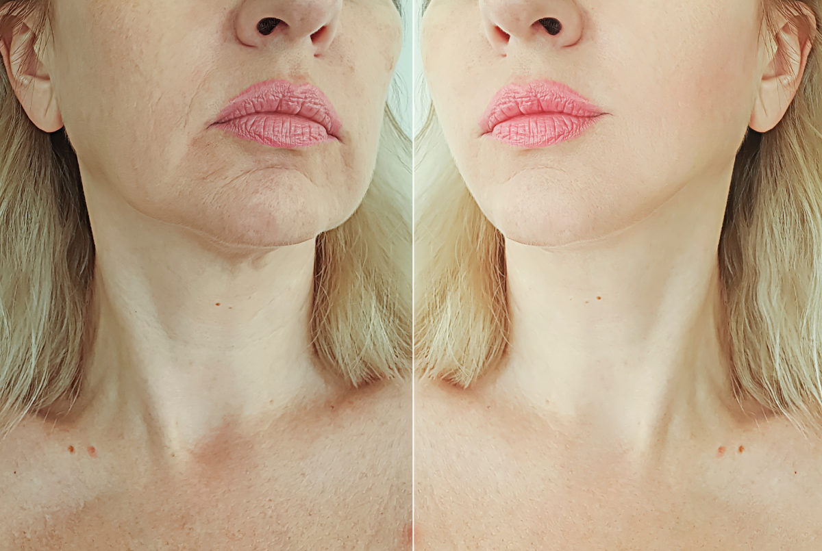 blanching de arrugas Albacete