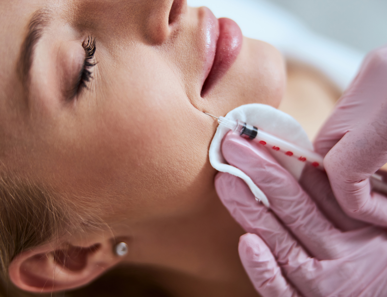 Surco nasogeniano Murcia